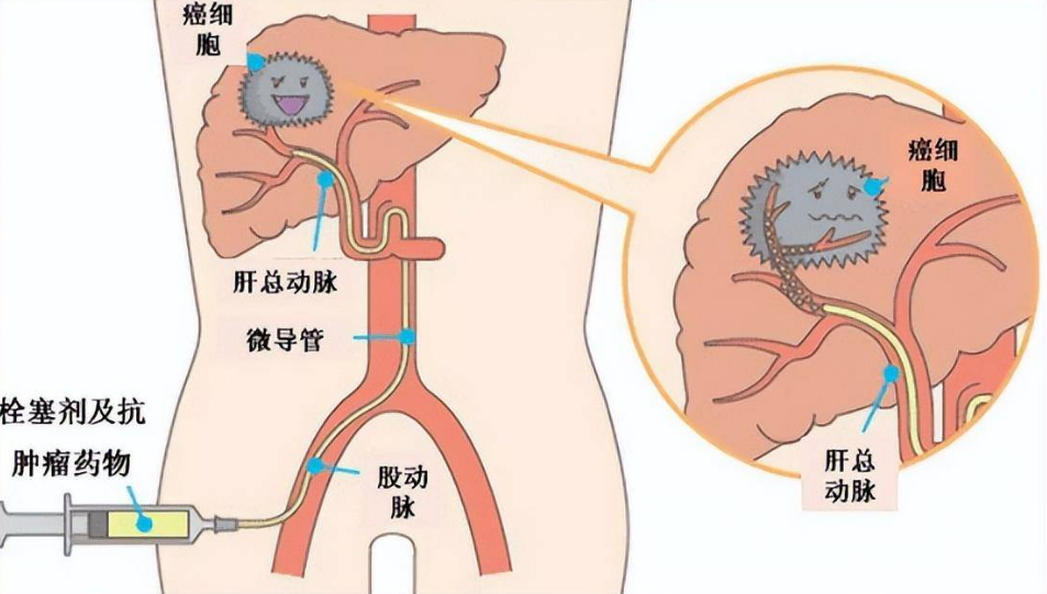 肝动脉化疗栓塞术（TACE）